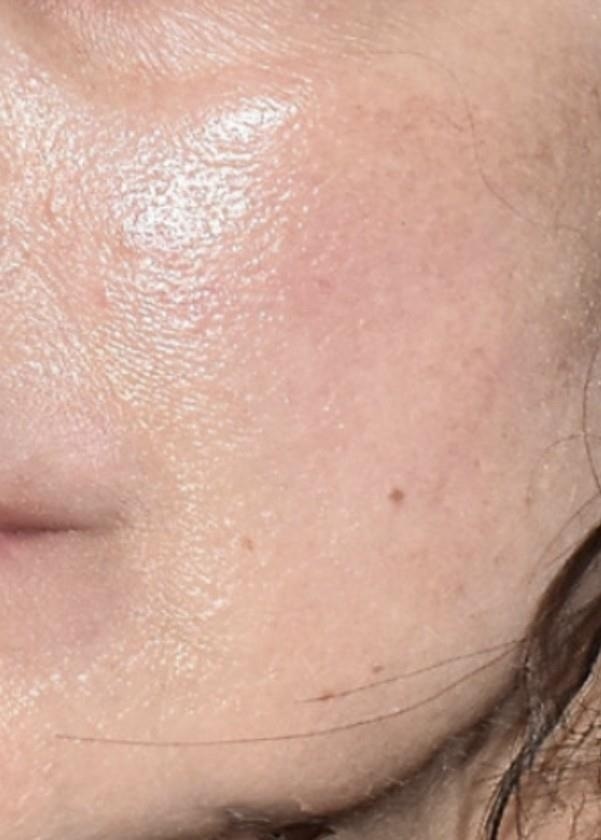 Rosacea After (1)