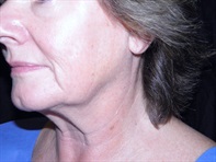 Dr. Serra Surgical Before & After