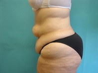 Dr. Serra Surgical Before & After